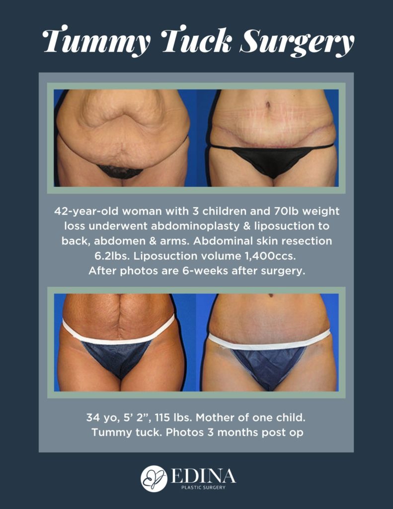 How to Reduce the Appearance of Your Tummy Tuck Scars - Berlet