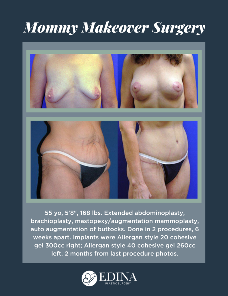 Beautiful Breasts and Waist After Mommy Makeover Procedure