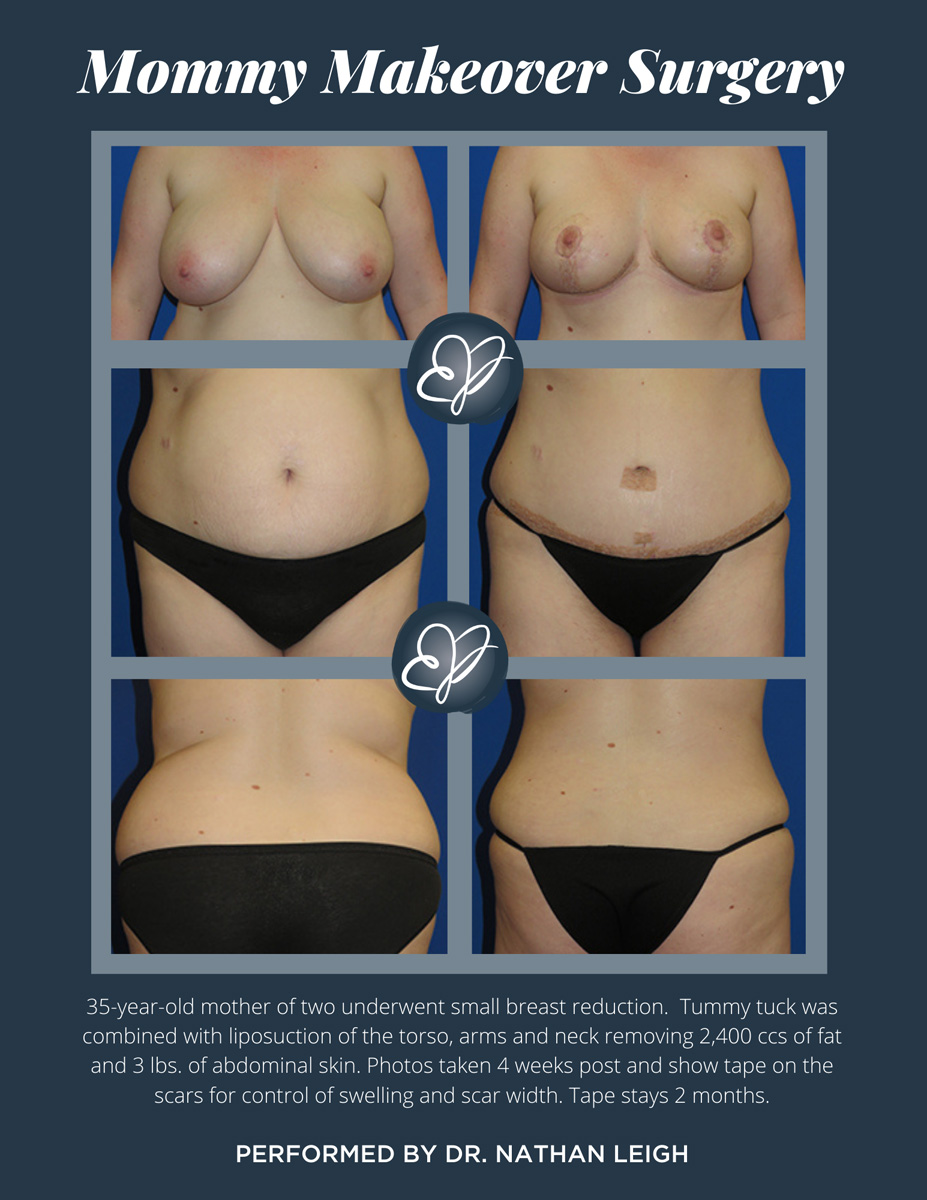 Patient 1482 Tummy Tuck, Breast Reduction, Mommy Makeover Before