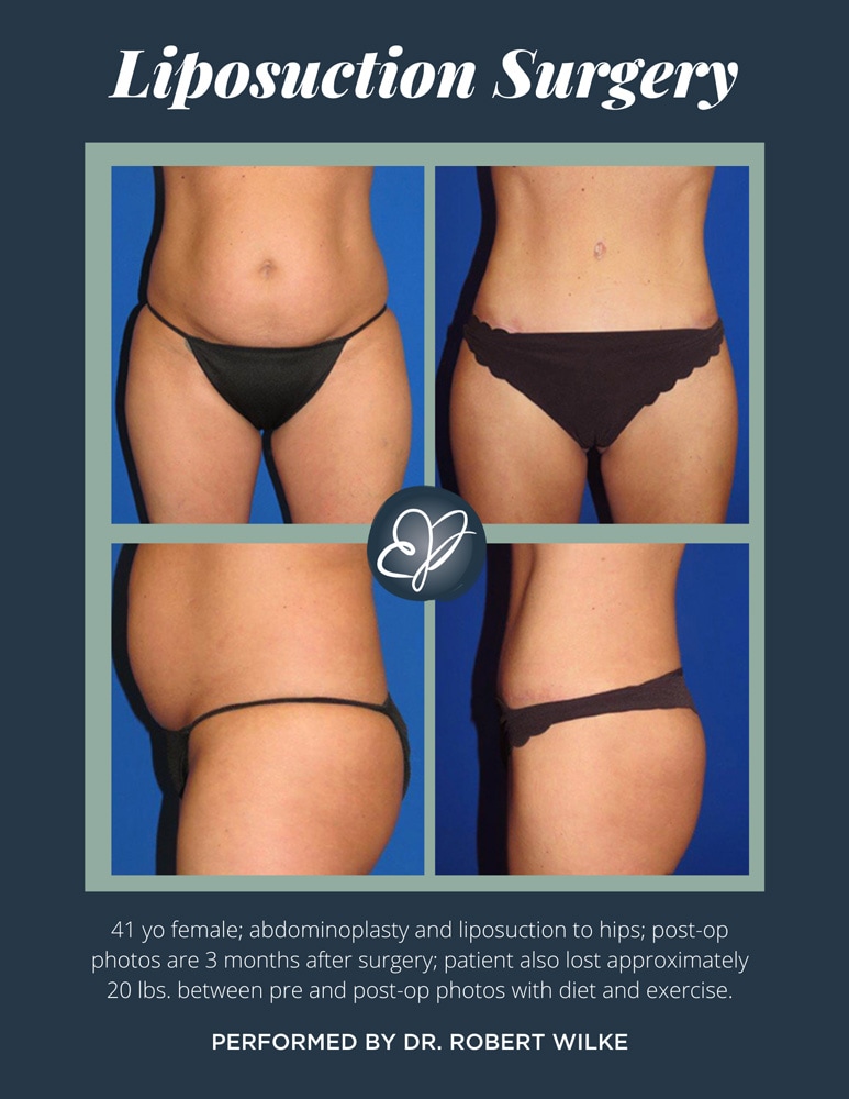 Reshape Specific areas of your Body through Liposuction Surgery