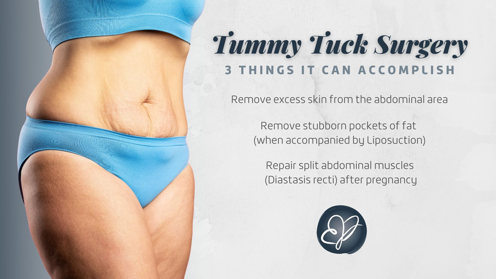 3 Types Of Tummy Tucks To Fit Your Needs — HZ Plastic Surgery