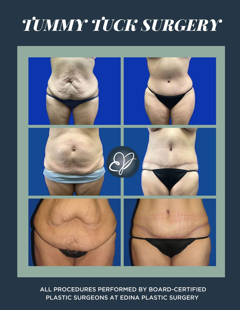Tummy tuck immediate before & after results 
