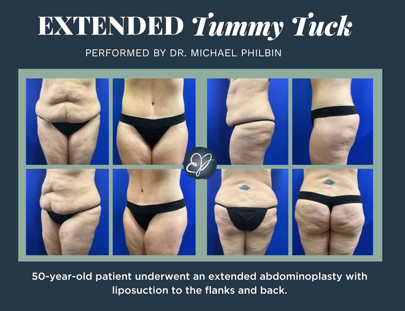 Extended Tummy Tuck (Body Lift) 2024