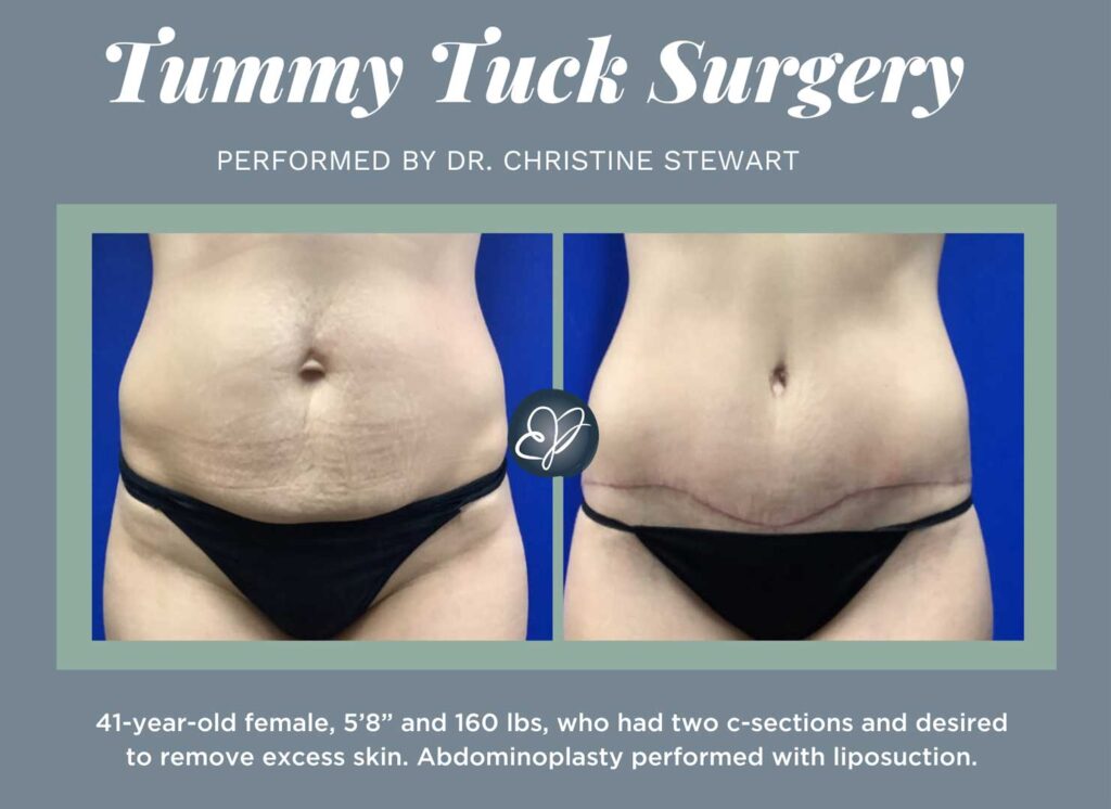 What happens to my belly button during a tummy tuck? - Staiano Plastic  Surgery